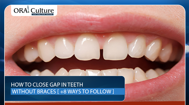 How to close gap in teeth without braces – 8 natural and cosmetic methods for a confident smile