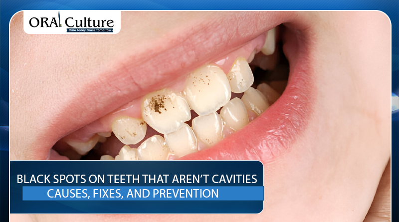 Close-up of teeth with black spots that aren’t cavities, showing surface stains. - oral culture