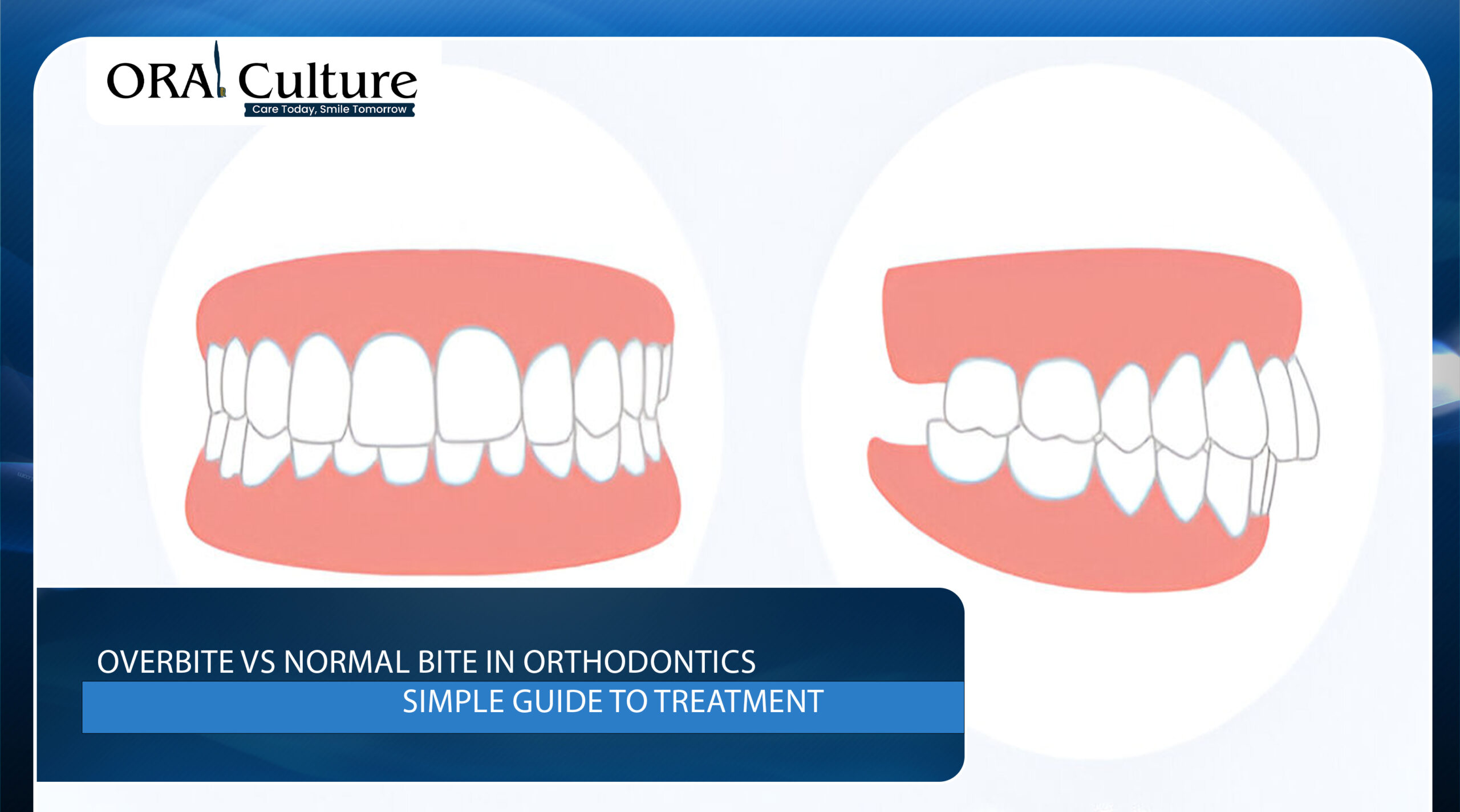 Overbite vs normal bite in orthodontics comparison with treatment guide illustration