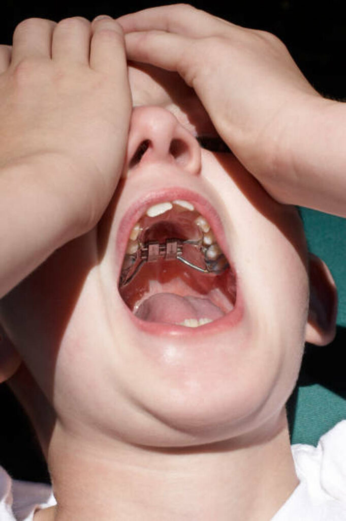 A child wearing a palate expander, used in a story about feeling it ruined their face.
