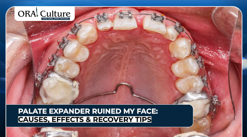 Palate expander in the upper jaw showing changes that made some feel it ruined their face