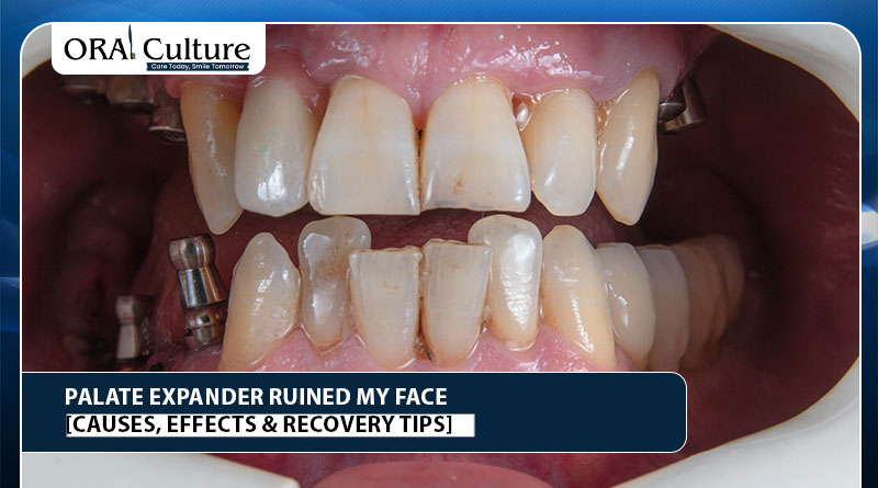 Palate Expander Ruined My Face [Causes, Effects & Recovery Tips]